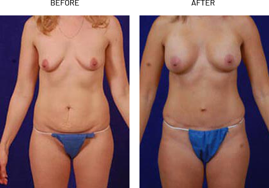 Liposuction in tummy area